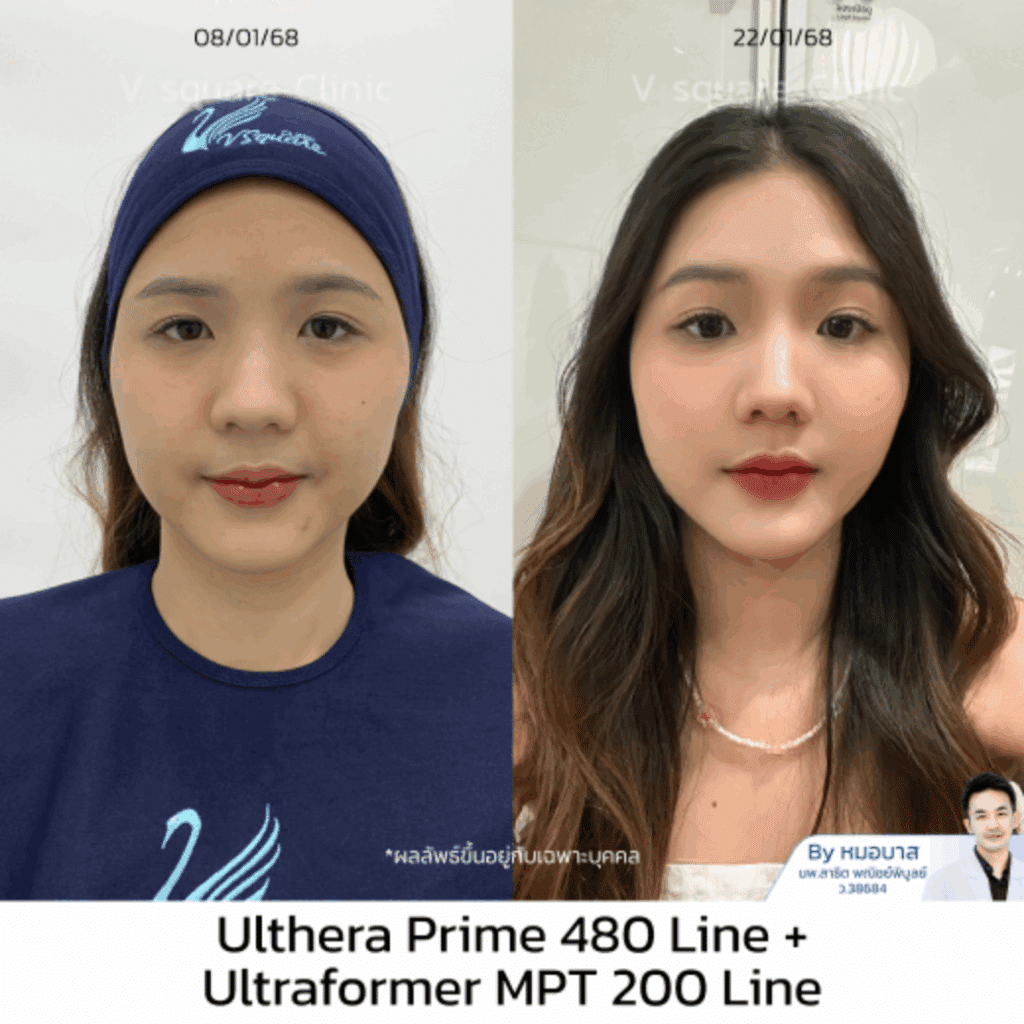 รีวิว Ultheraหน้า_เอิร์น UL RR+MPT