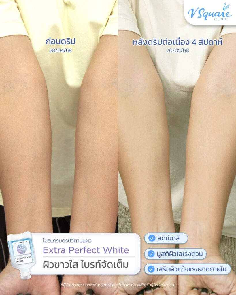 รีวิว ฉีดผิวแล้วขาวจริงไหม