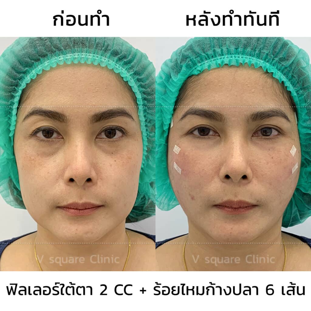 รีวิว ร้อยไหมก้างปลา_คุณมาย