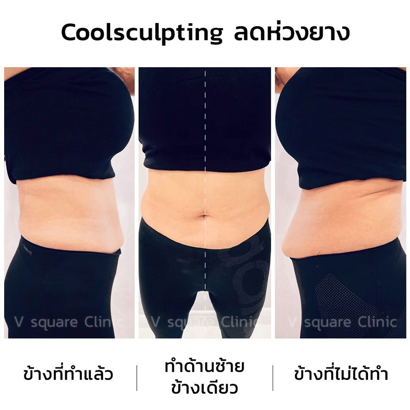 รีวิวCoolsculpting หน้าท้อง