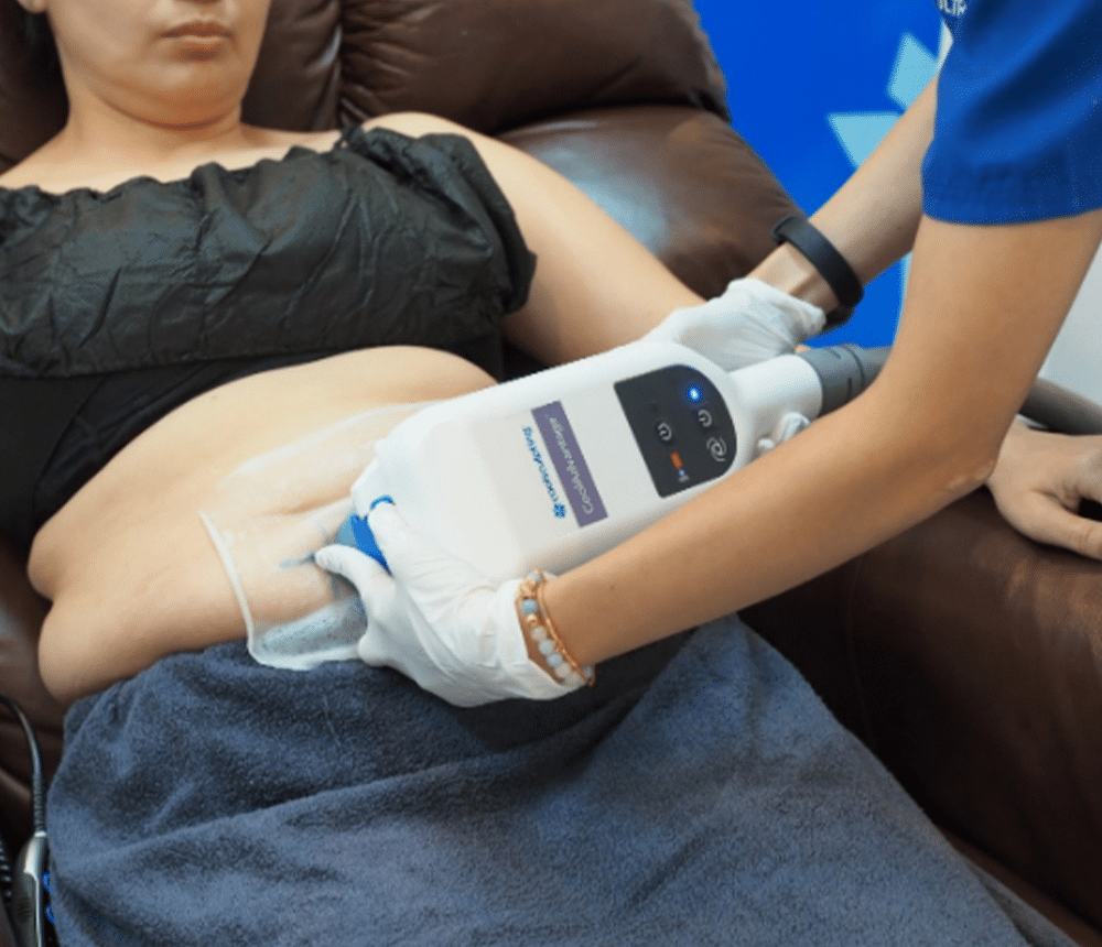 รีวิวCoolsculpting หน้าท้อง