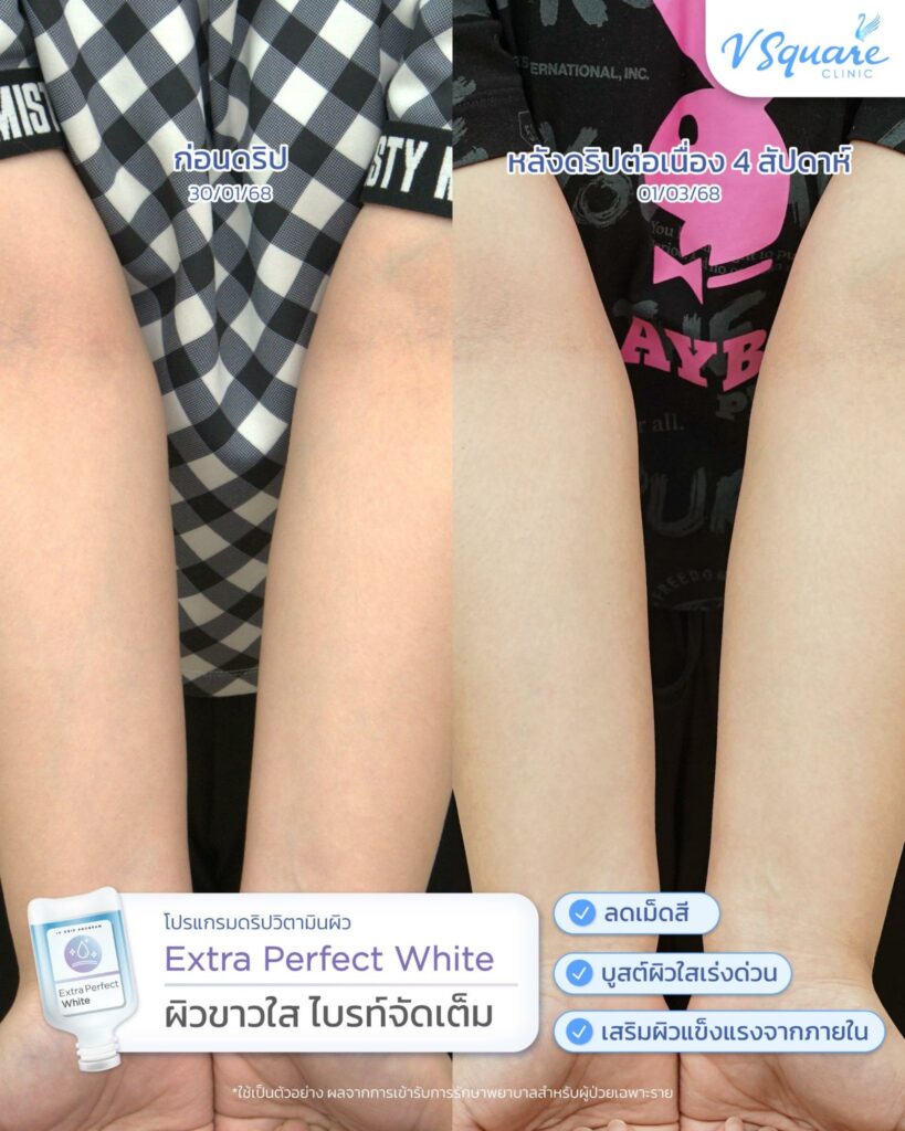 รีวิวฉีดผิวขาวขาวจริงไหม
