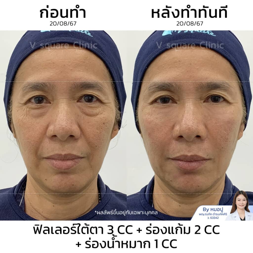 รีวิวฉีดฟิลเลอร์ ราคาเหมาะสม_คุณชมพู่ (มีผลลัพธ์โบท็อกซ์)