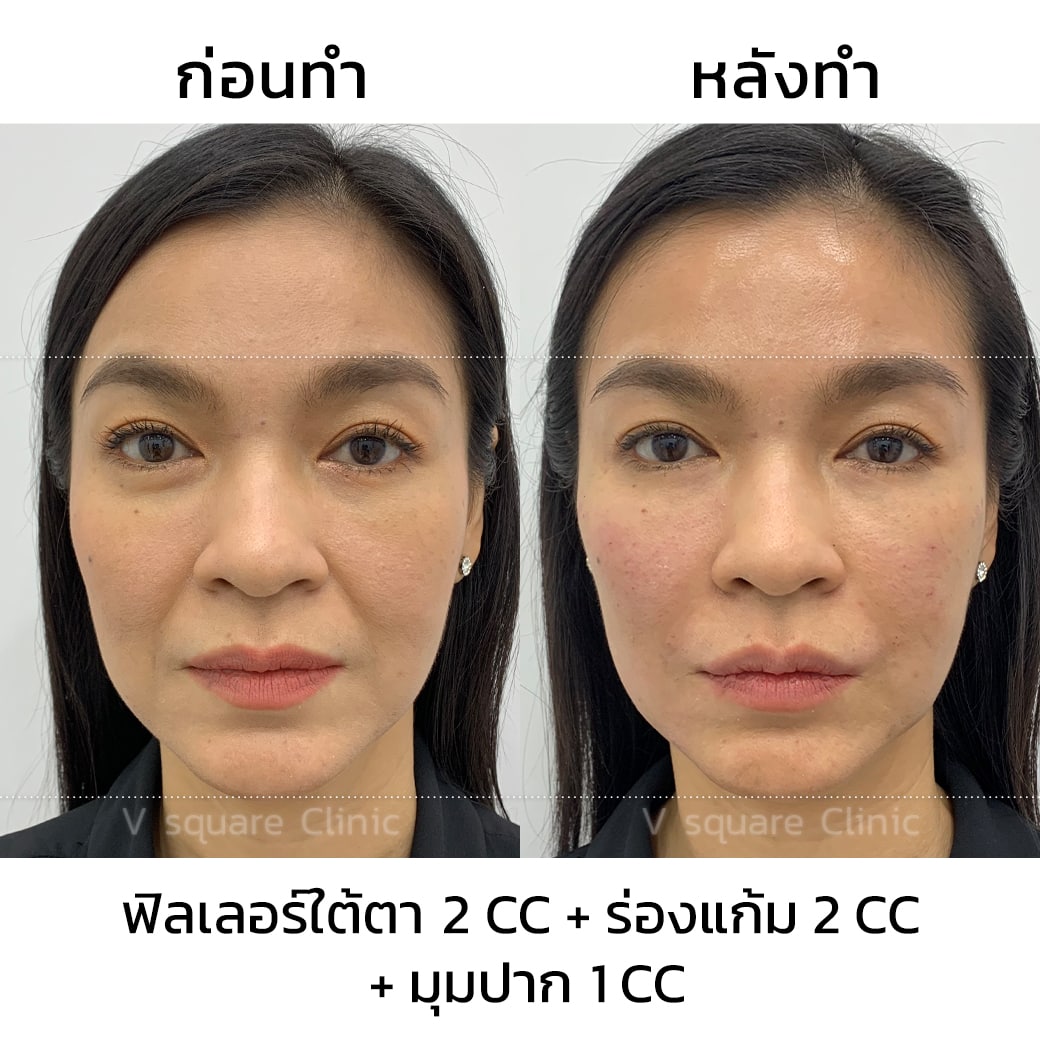 รีวิวฉีดฟิลเลอร์_คุณแอน