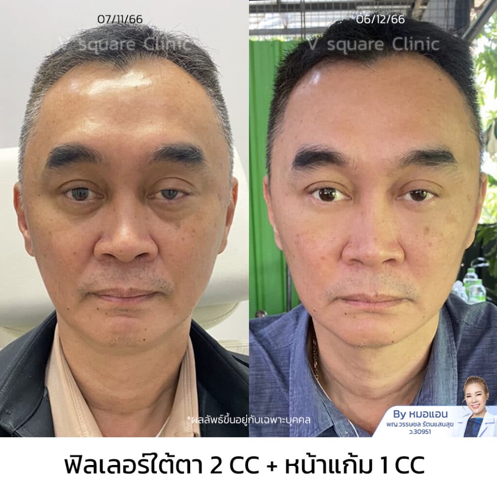 รีวิวฉีดฟิลเลอร์ใต้ตา_คุณปริญญา