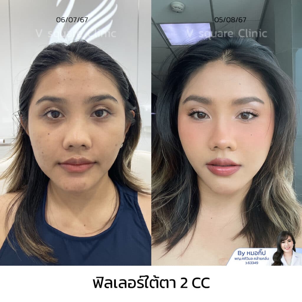 รีวิวฉีดฟิลเลอร์ใต้ตา_คุณเพลง อินฟลู