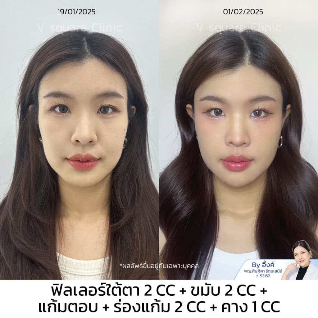 รีวิวฉีดฟิลเลอร์ใต้ตา_น้ำ