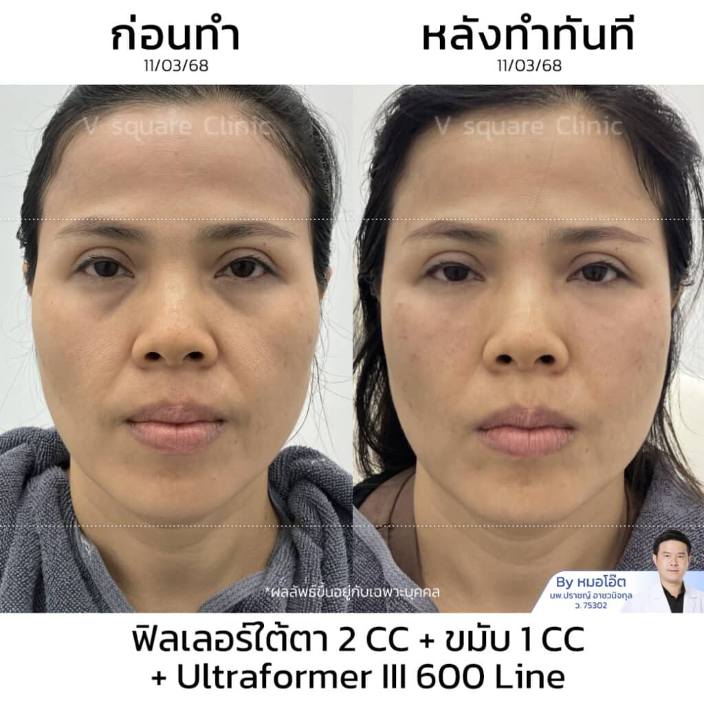 รีวิวฉีดฟิลเลอร์ใต้ตา_บุษรา ไก่แก้ว