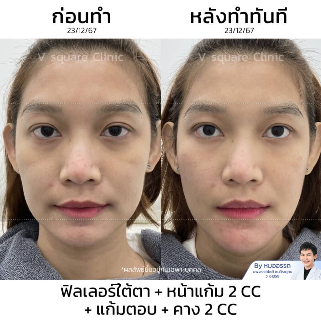 รีวิวฉีดฟิลเลอร์ใต้ตา_สุมิตา ลักษณาวงศ์