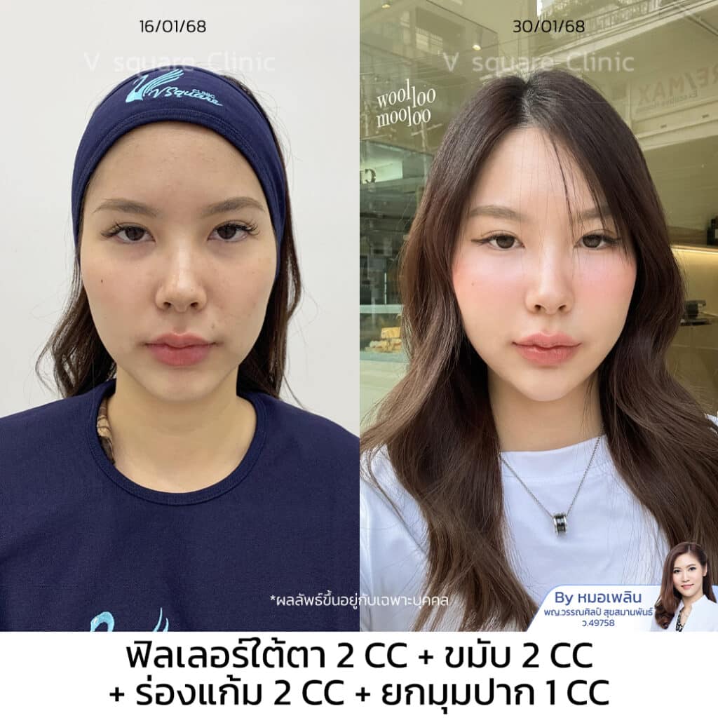 รีวิวฉีดฟิลเลอร์ใต้ตา_เฟิร์น