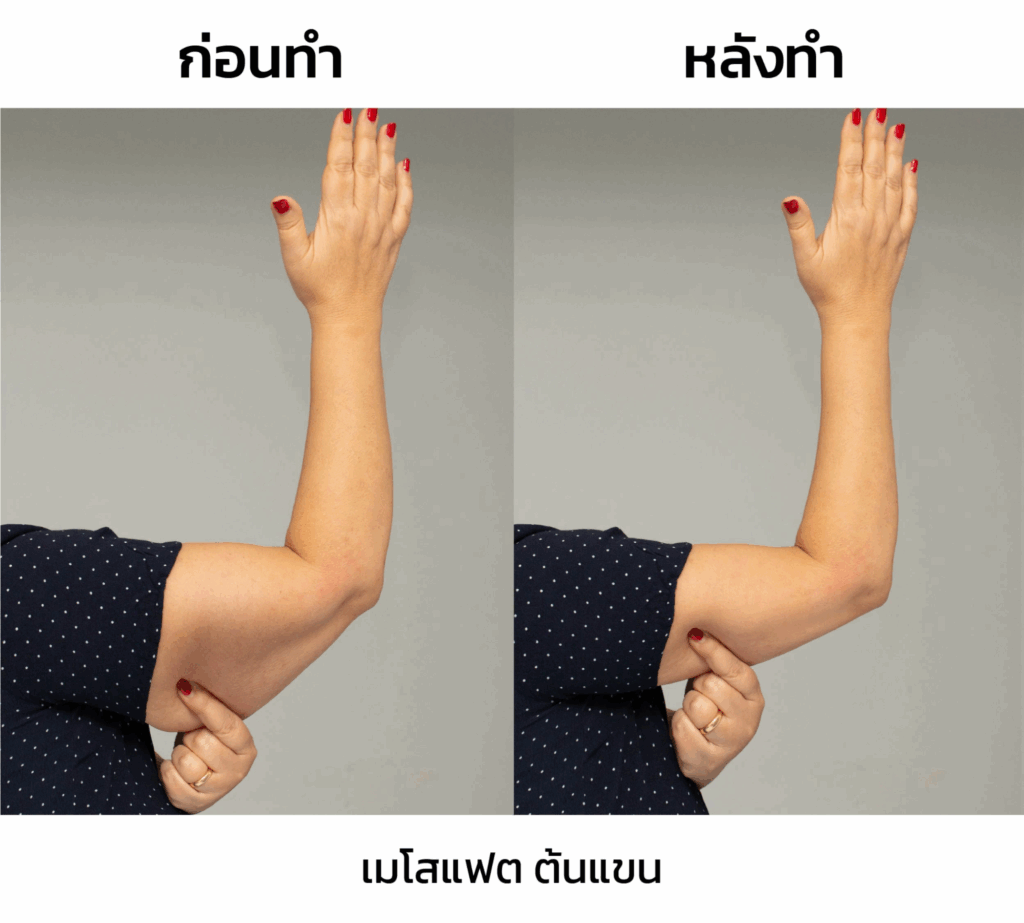รีวิวฉีดเมโสต้นแขน(1)