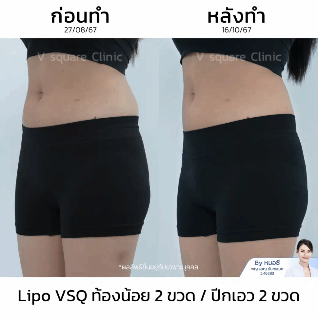 รีวิวฉีดเมโสแฟตหน้าท้อง_คุณปาร์ม