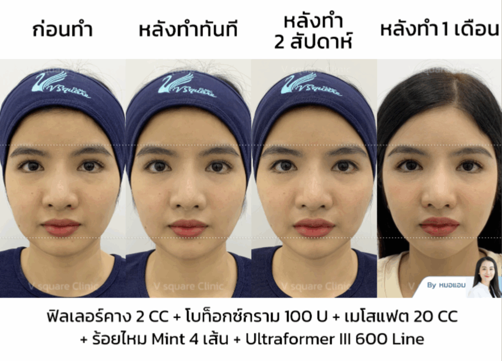 รีวิวฉีดโบกราม_คุณซานตี้ Influencer (คอนเทนต์หน้าเรียว)