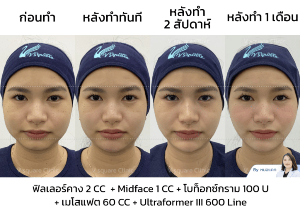 รีวิวฉีดโบท็อกซ์กราม