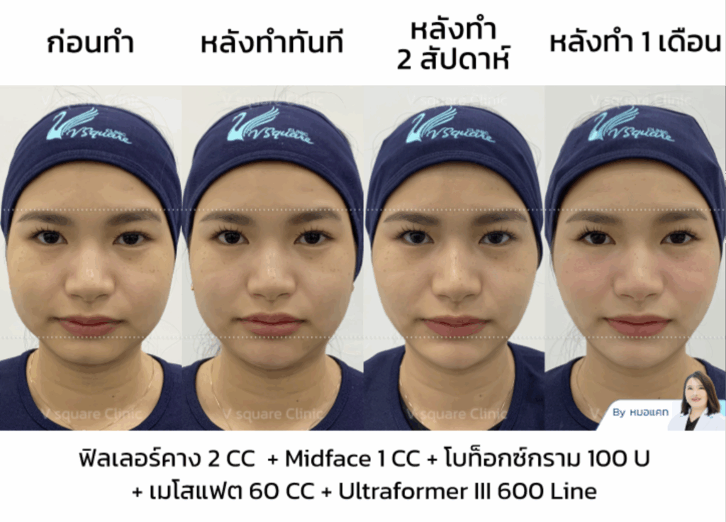 รีวิวฉีดโบท็อกซ์กราม_คุณเนย Influencer (คอนเทนต์หน้าเรียว)