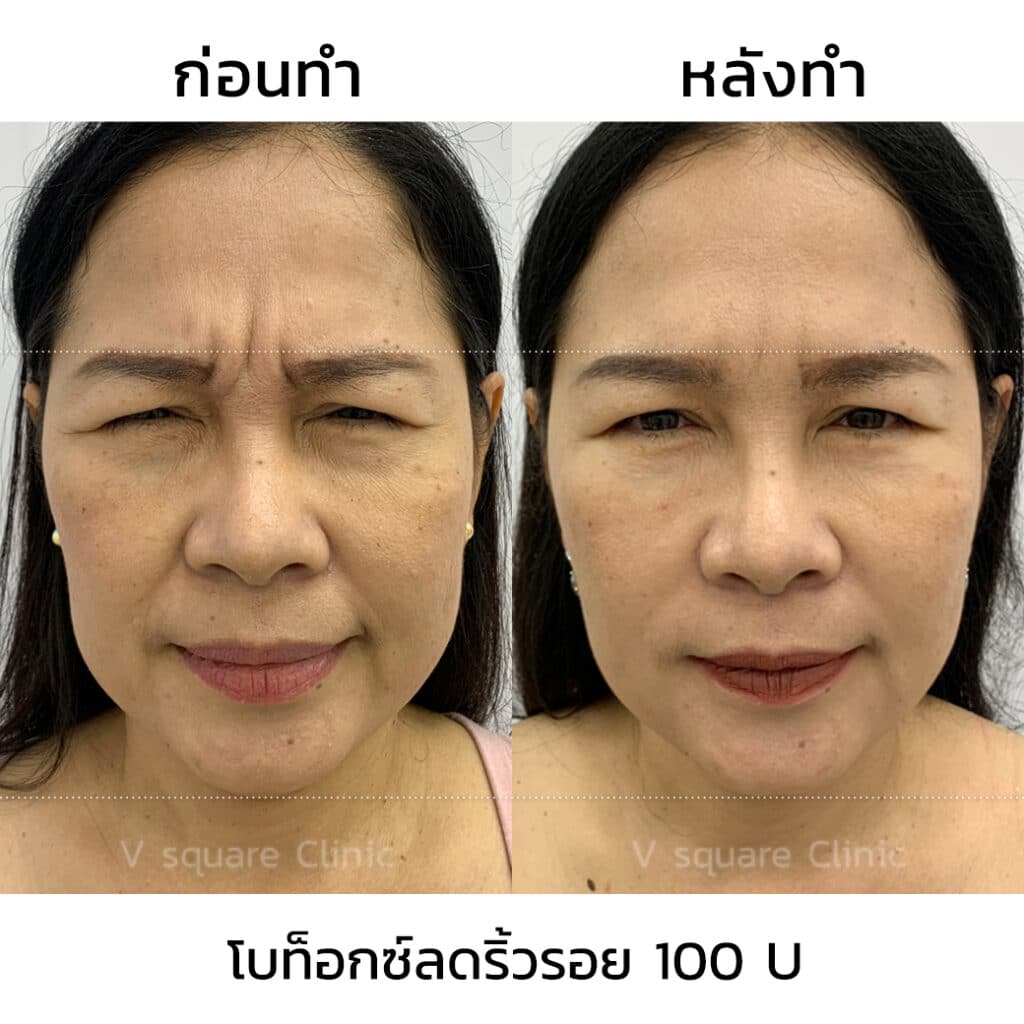 รีวิวฉีดโบท็อกริ้วรอย