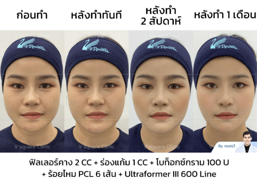รีวิวฉีดโบท็อกลดกราม