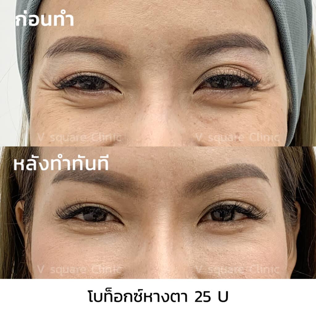 รีวิวฉีดโบท็อกลดริ้วรอยหางตา_คุณกุ้ง