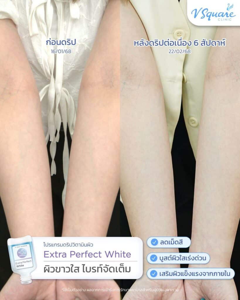 รีวิวดริปวิตามินผิวใส