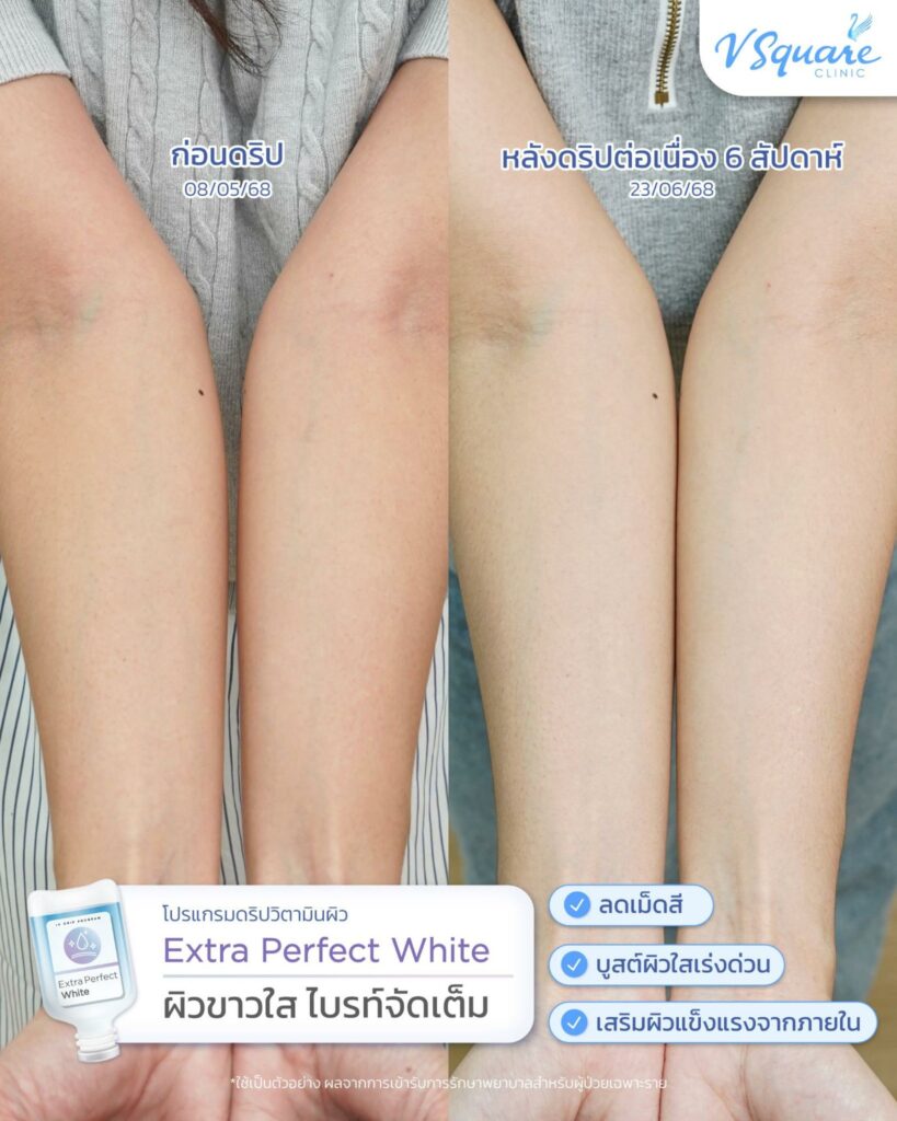รีวิวดริปวิตามินผิวไบรท์