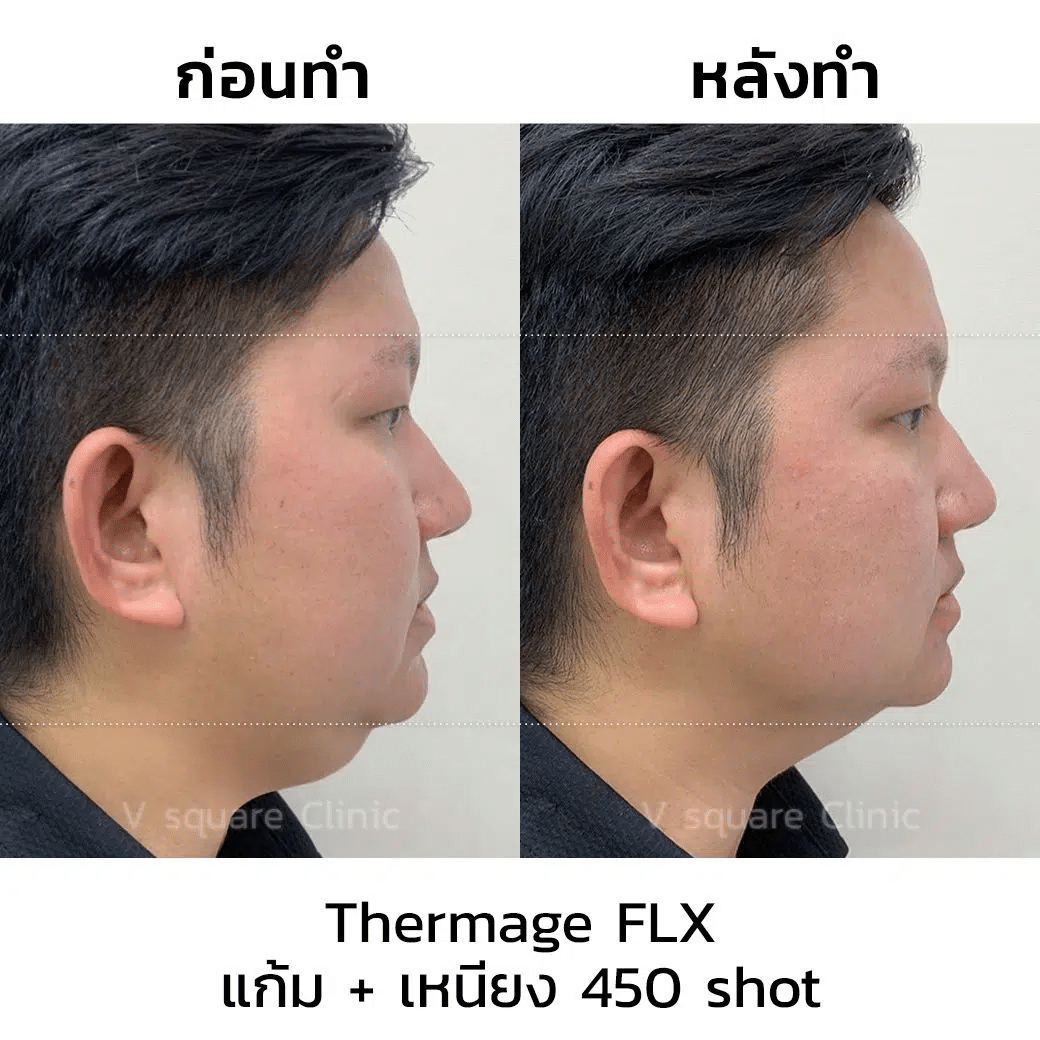 รีวิวทำ Thermage ใช้ 450 Shot