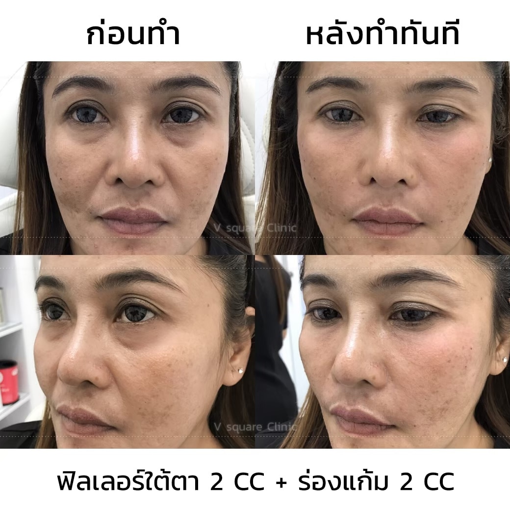 รีวิวฟิลเลอร์
