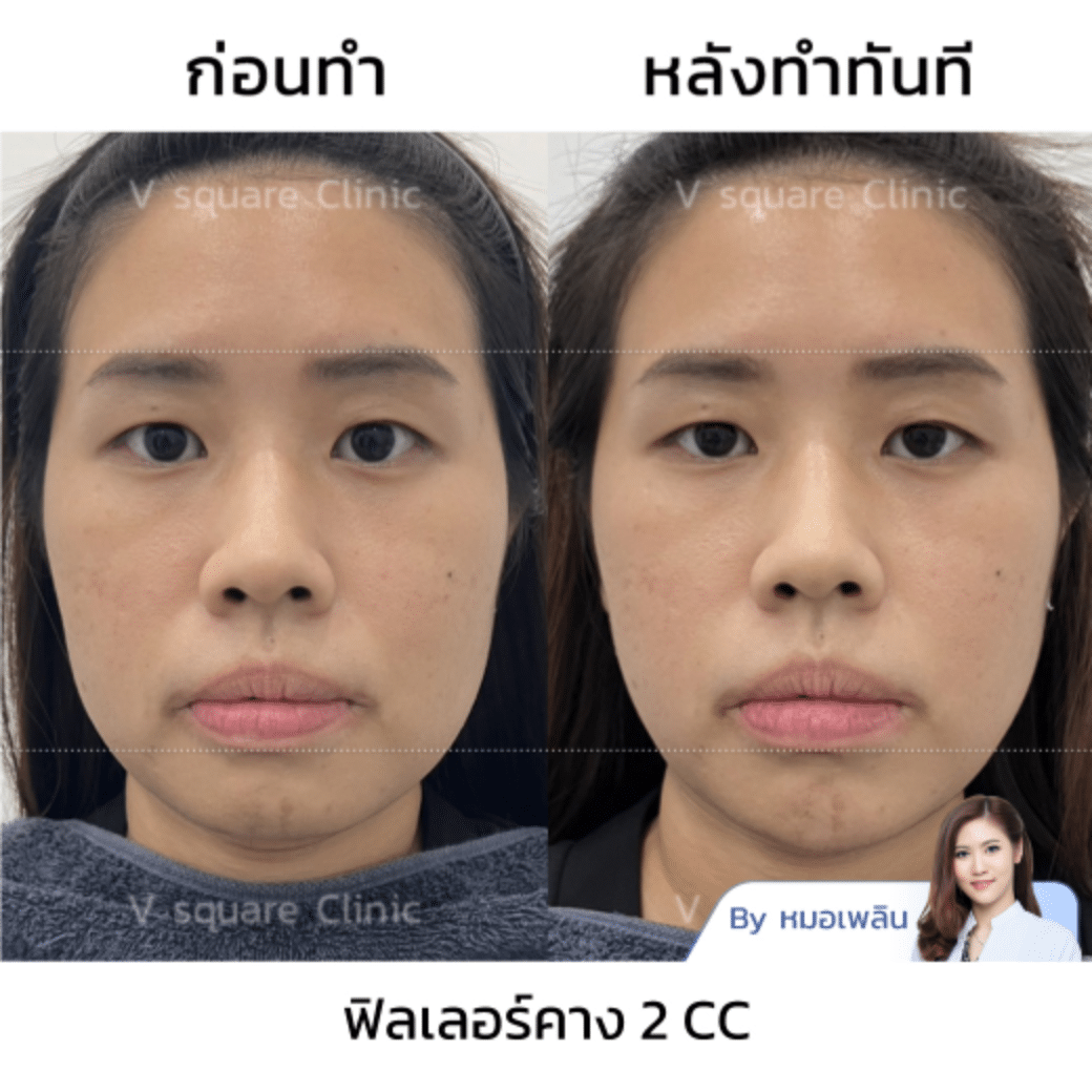 รีวิวฟิลเลอร์คางฉีดยี่ห้อปลอดภัย