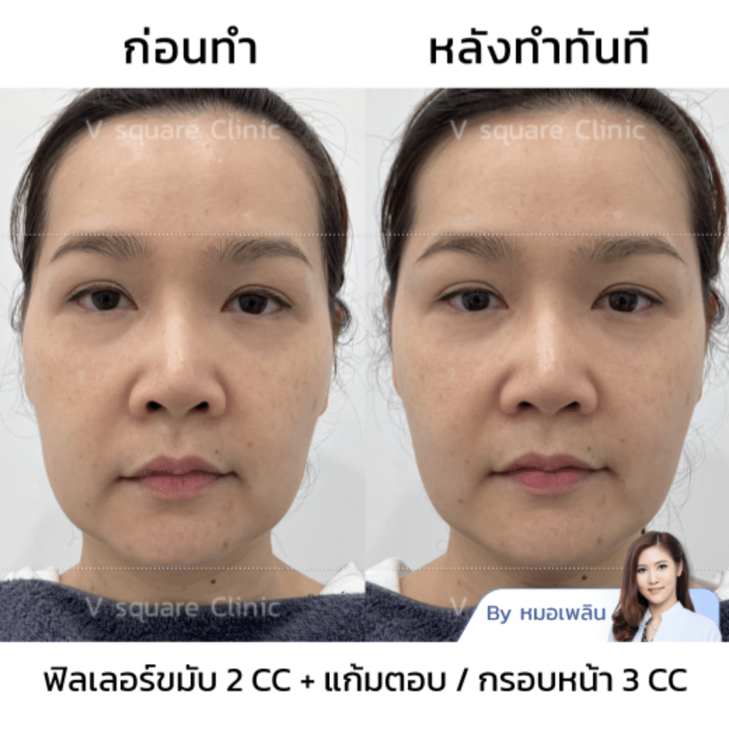 รีวิวฟิลเลอร์คางยี่ห้อผ่าน อย