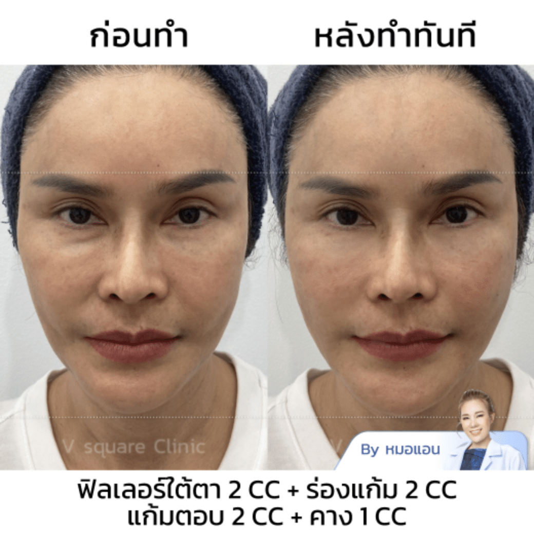 รีวิวฟิลเลอร์ร่องแก้ม