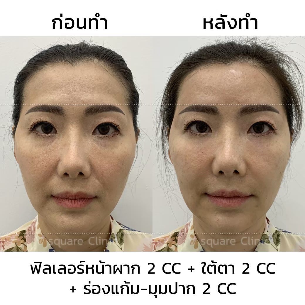 รีวิวฟิลเลอร์หน้าผาก