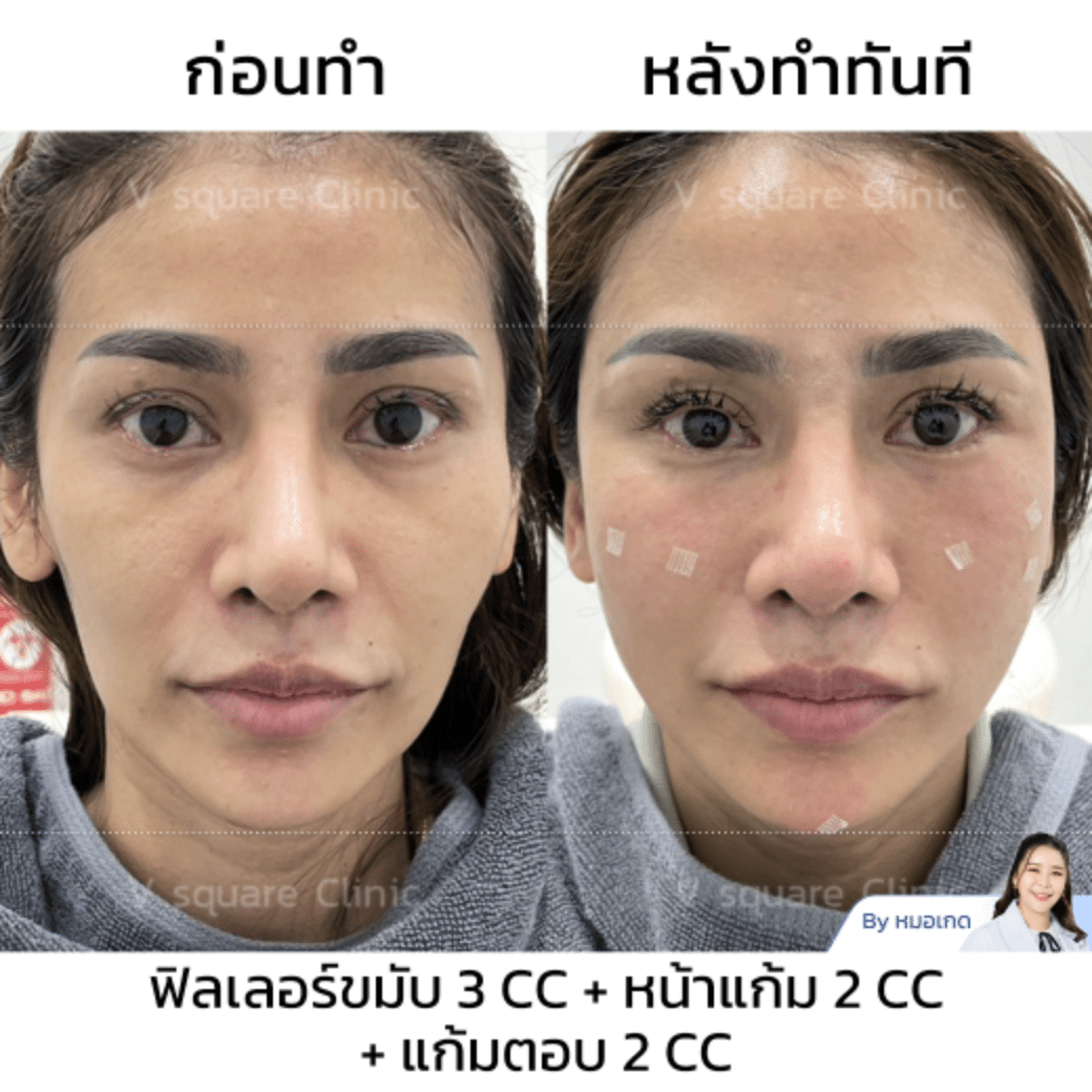 รีวิวฟิลเลอร์แก้มส้ม