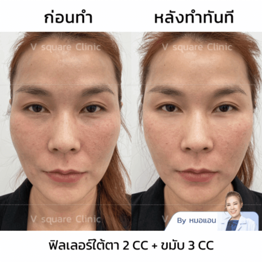 รีวิวฟิลเลอร์ใต้ตายี่ห้อปลอดภัย
