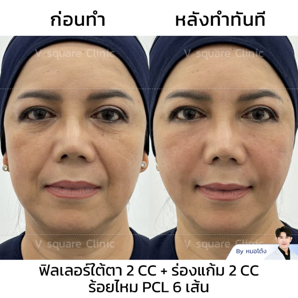 รีวิวร้อยไหม PCL_แม่เปิ้ล Influencer