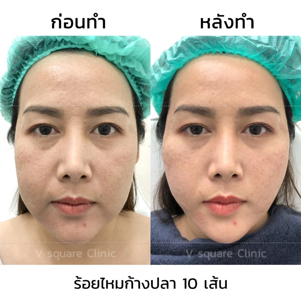 รีวิวร้อยไหมก้างปลา_R0112