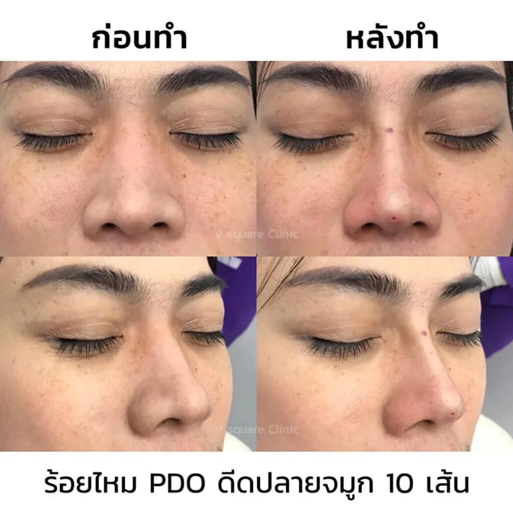 รีวิวร้อยไหมจมูก_R0102