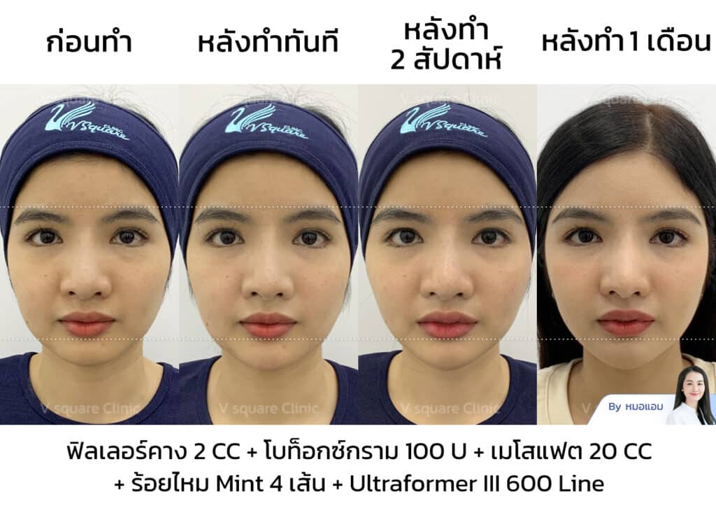 รีวิวร้อยไหมมิ้นท์_คุณซานตี้ Influencer (คอนเทนต์หน้าเรียว)