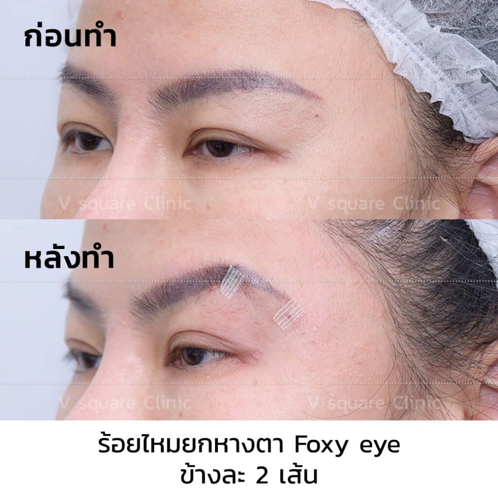 รีวิวร้อยไหมยกหางตา Foxy eye_R0069