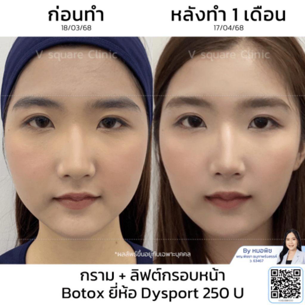 รีวิวลิฟกรอบหน้า_คุณคาโอริ_โดยหมอพิช