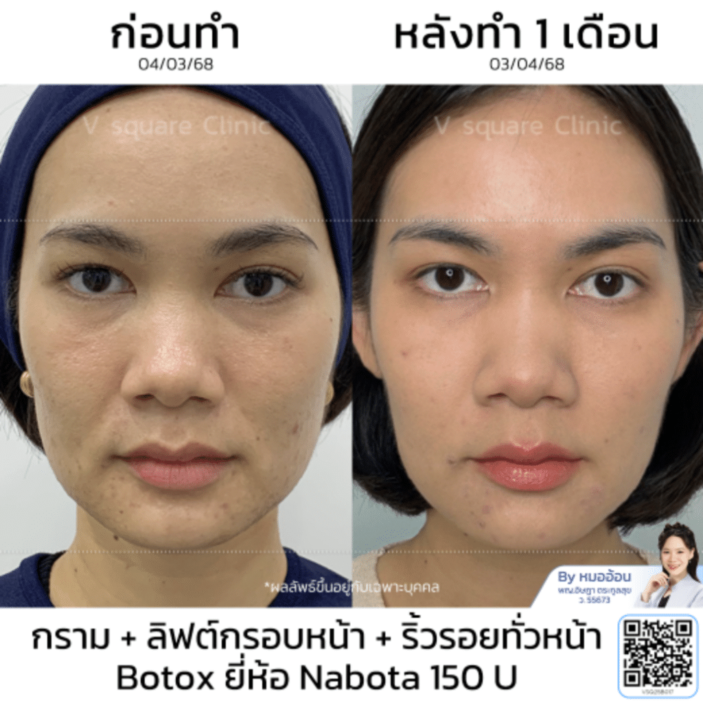รีวิวลิฟกรอบหน้า_คุณน้ำ_โดยหมออ้อน