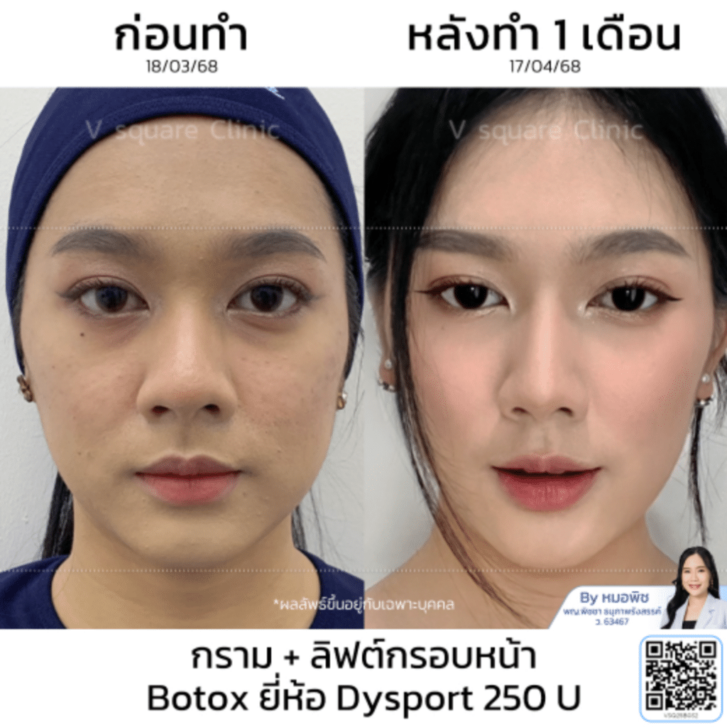 รีวิวลิฟกรอบหน้า_คุณยาหยี_โดยหมอพิช
