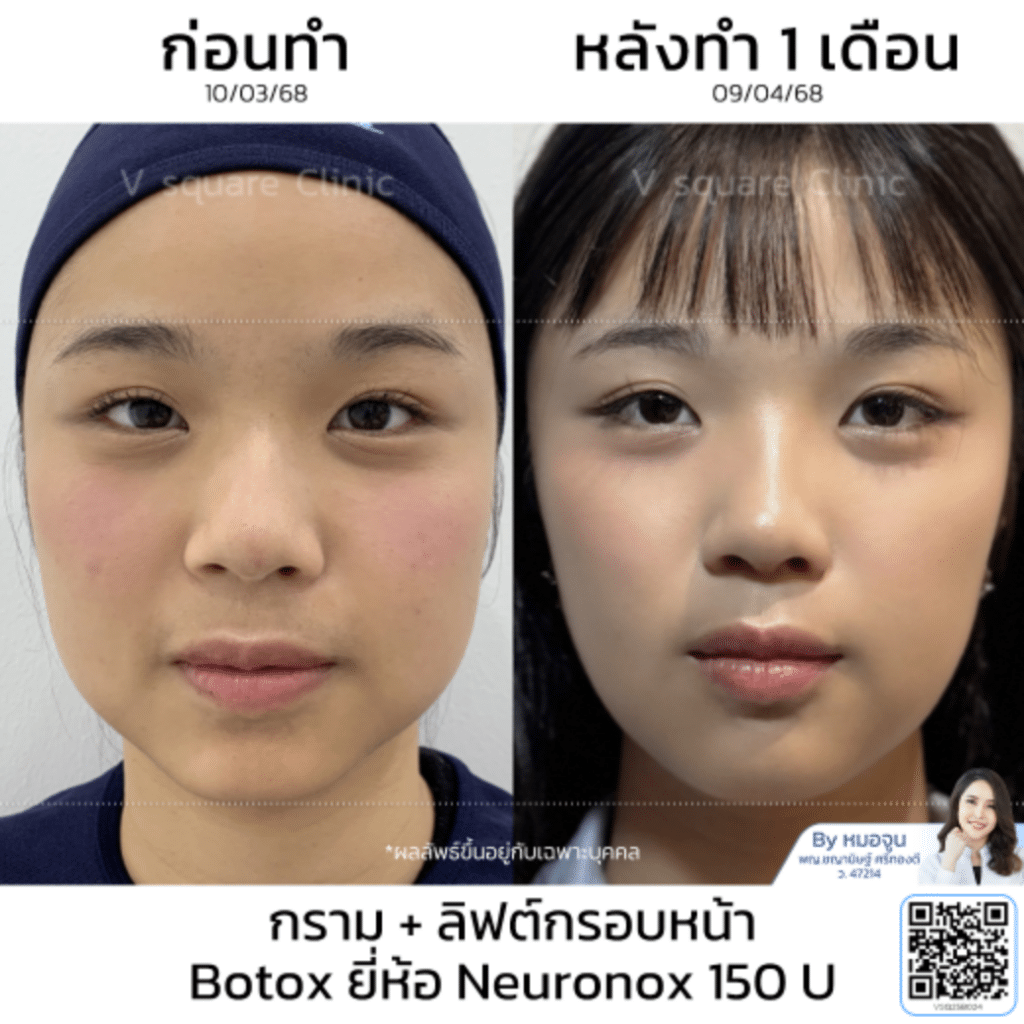 รีวิวลิฟกรอบหน้า_คุณอะตอม_โดยหมอจูน