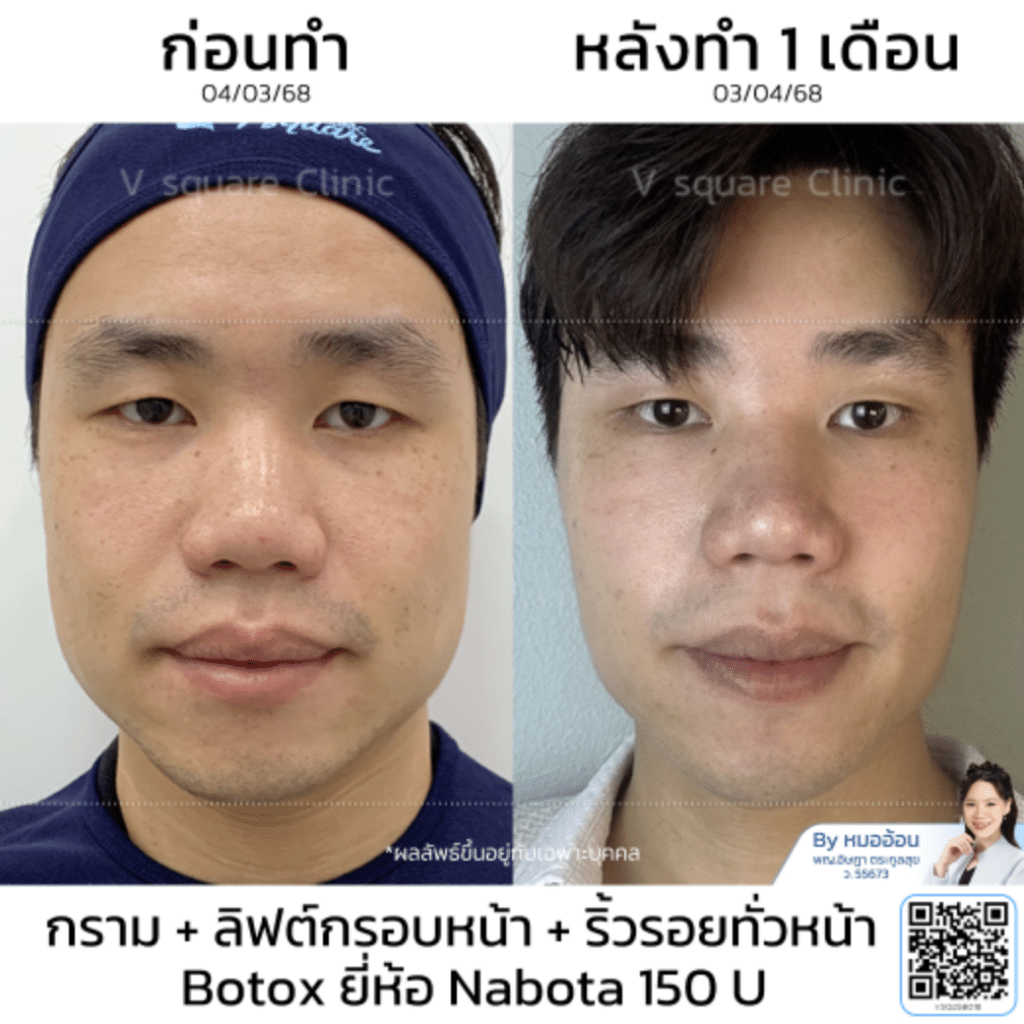 รีวิวลิฟกรอบหน้า_คุณเต้_โดยหมออ้อน