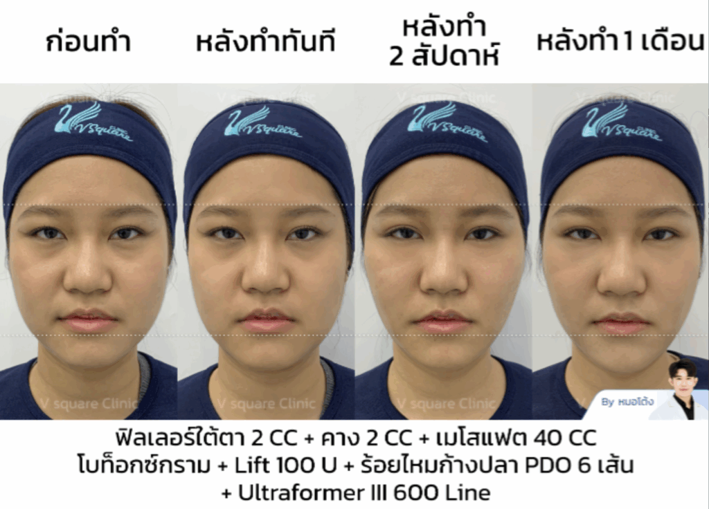 รีวิวเมโสแฟต_แจน