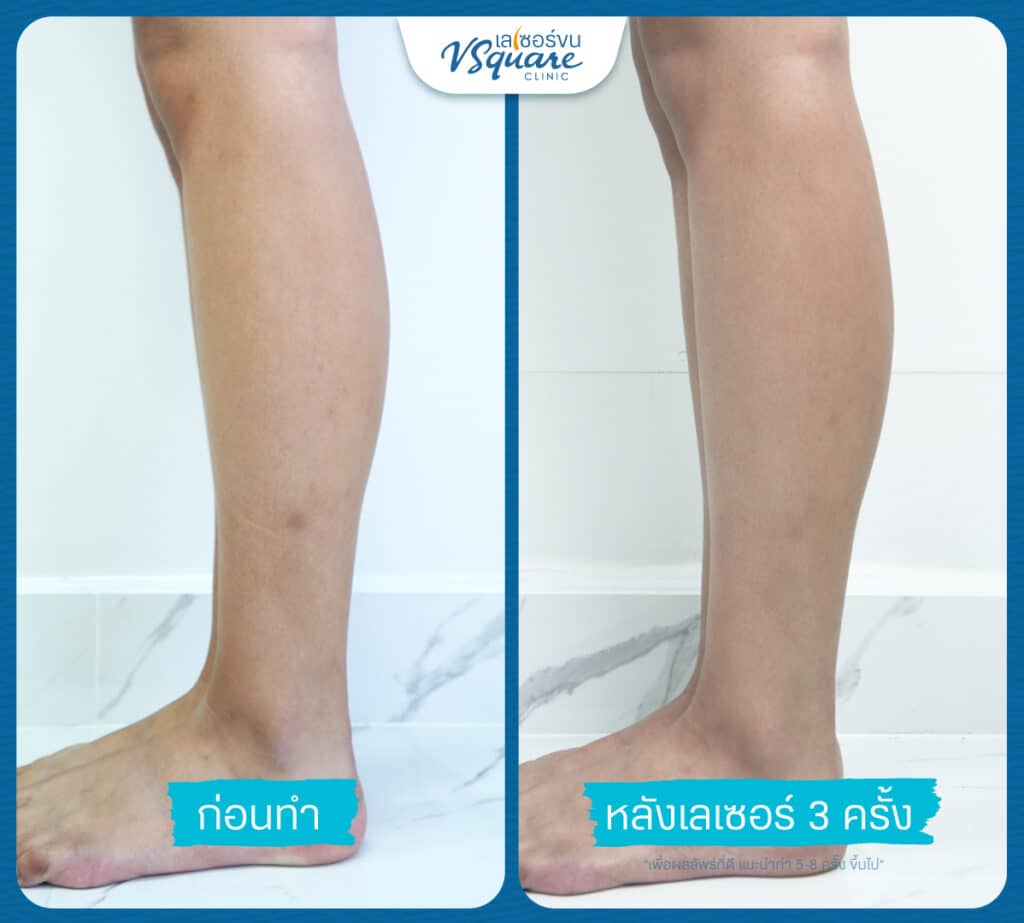 รีวิวเลเซอร์ขนขา