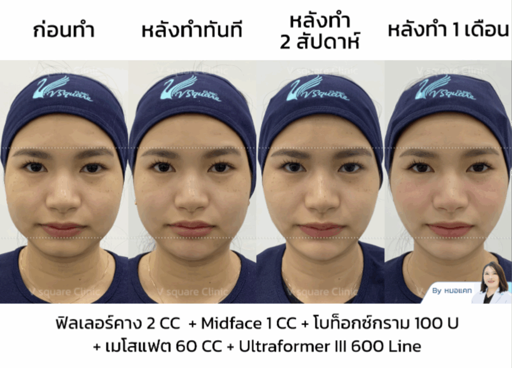 รีวิวโบท็อกกราม_คุณเนย