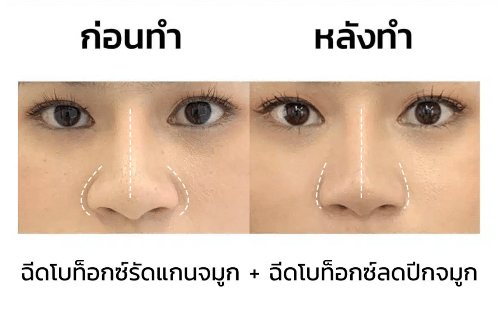 รีวิวโบท็อกจมูก