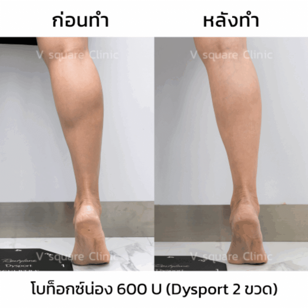 รีวิวโบท็อกน่อง_คุณแจน