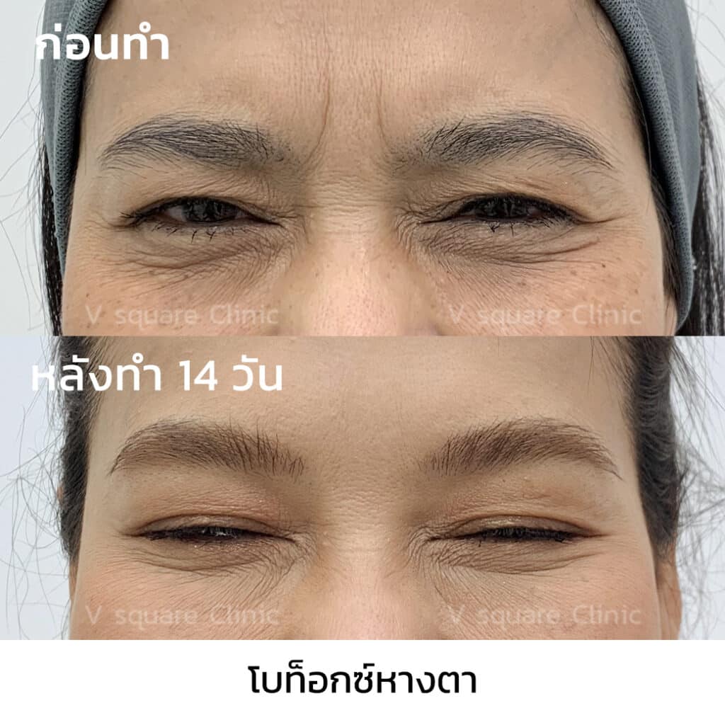 รีวิวโบท็อกหางตา_คุณยุ้ย