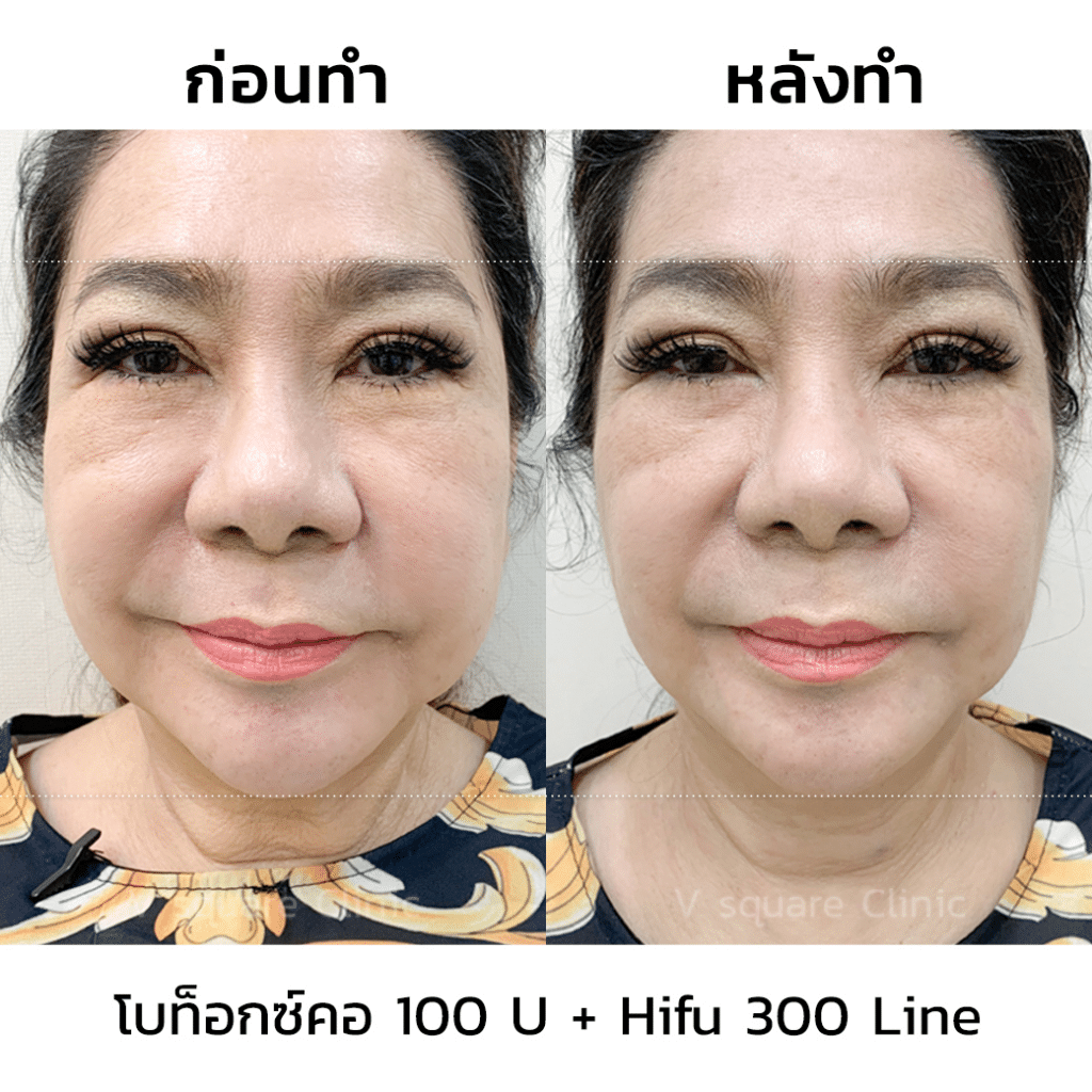 รีวิวโบท็อลิฟกรอบหน้า