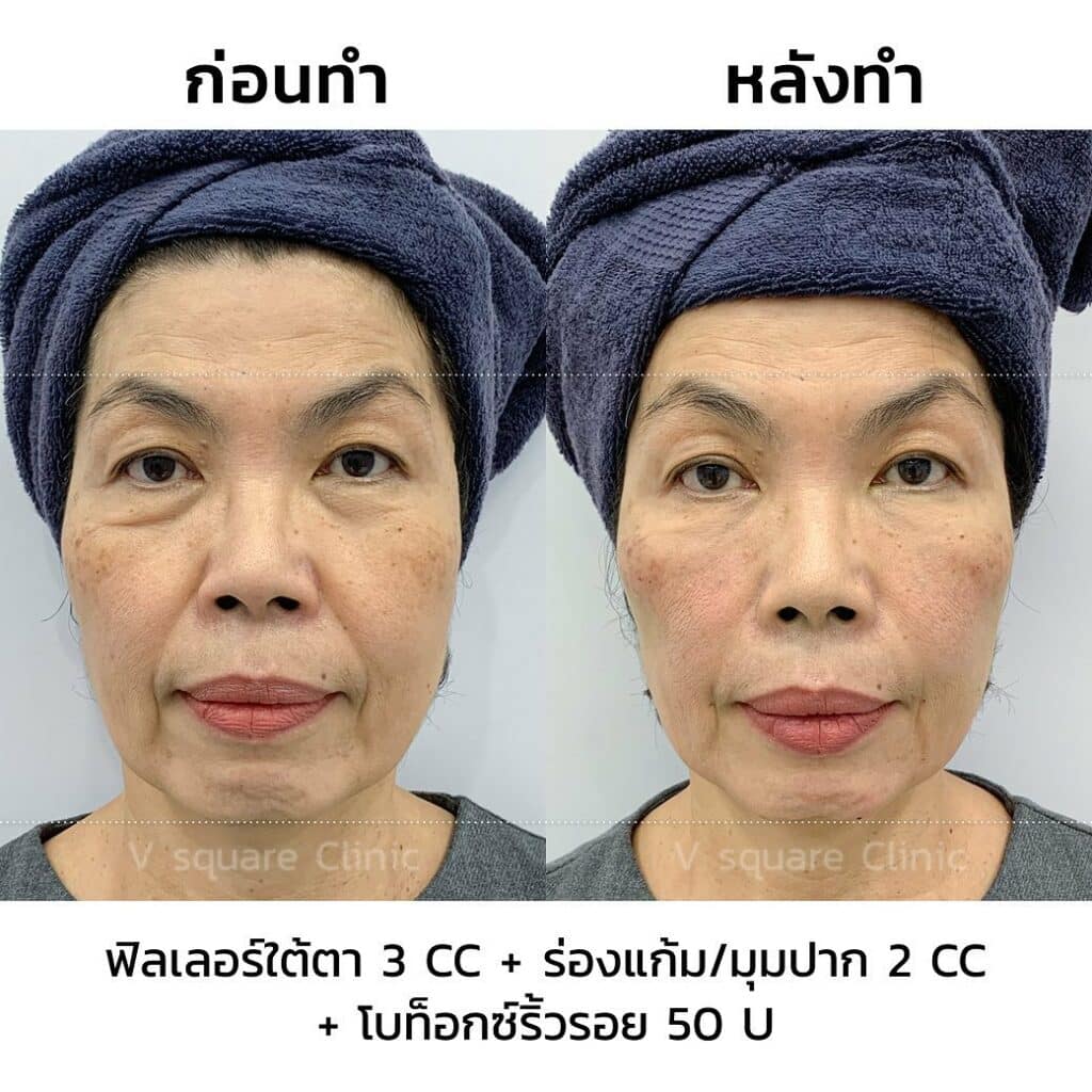 รีวิวโบริ้วรอย